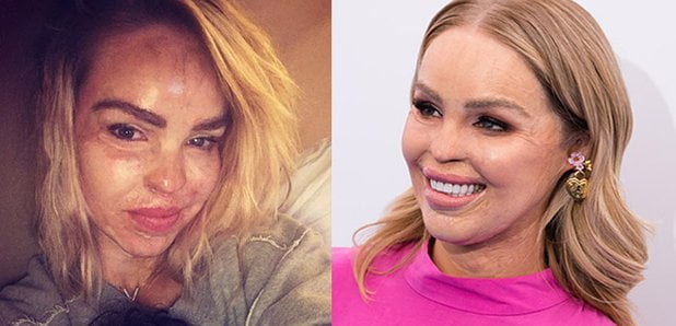 Katie Piper earlier than and after acid attack 1