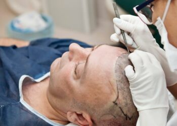 Where to Find the Best Hair Transplant in Mexico City?