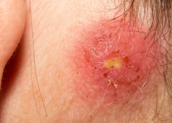Staph Skin Infection Treatments – The Ultimate Guide To Staph Prevention