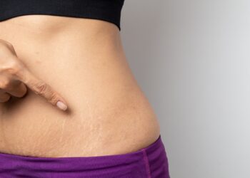 How to Get Rid of Stretch Marks