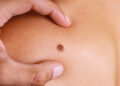 Skin Cancer White Spots Treatment with Laser