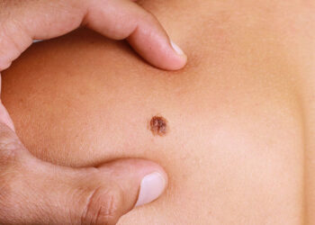 Skin Cancer White Spots Treatment with Laser