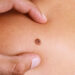 Skin Cancer White Spots Treatment with Laser
