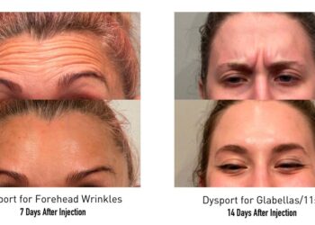 Dysport vs Botox: Comparing Two Popular Wrinkle Treatments