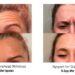 Dysport vs Botox: Comparing Two Popular Wrinkle Treatments